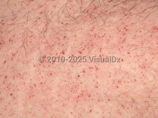 Clinical image of Fabry disease - imageId=1016028. Click to open in gallery.  caption: 'Close-up of myriad tiny red macules and papules (angiokeratomas).'