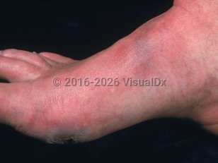 Peripheral arterial disease