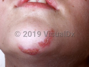 Clinical image of Berylliosis - imageId=1031671. Click to open in gallery.  caption: 'Curvilinear scaly and crusted erythematous plaques on the chin.'