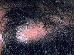 Clinical image of Traumatic alopecia - imageId=1034378. Click to open in gallery.  caption: 'A hairless scar on the scalp, secondary to forceps delivery 30 years prior.&nbsp;'