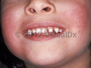 Clinical image of Erythema infectiosum - imageId=105902. Click to open in gallery.  caption: 'Erythematous patches on the cheeks giving rise to the "slapped cheek" appearance.'
