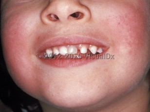Clinical image of Erythema infectiosum - imageId=105902. Click to open in gallery.  caption: 'Erythematous patches on the cheeks giving rise to the "slapped cheek" appearance.'