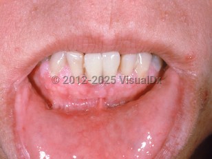 Clinical image of Cowden disease - imageId=1061888. Click to open in gallery.  caption: 'Numerous papules on the gingival mucosa and tiny skin-colored and whitish papules on the upper cutaneous lip (trichilemmomas).'