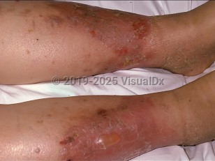 Clinical image of Stasis dermatitis - imageId=108674. Click to open in gallery.  caption: 'Large, scaly, and eroded erythematous plaques with overlying bulla formation on the shins.'