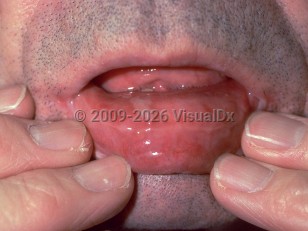 Mucous membrane pemphigoid