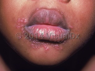 Clinical image of Periorificial dermatitis of childhood - imageId=1172467. Click to open in gallery.  caption: 'Numerous substantive pink papules around the mouth.'