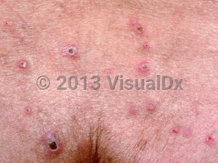 Clinical image of Reactive perforating collagenosis - imageId=1278595. Click to open in gallery.  caption: 'A close-up of numerous erythematous papules with central thick crusts.'