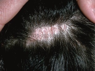 Clinical image of Lichen planopilaris - imageId=143971. Click to open in gallery.  caption: 'A close-up of late stage lichen planopilaris showing a wrinkled pink-white plaque of scarring alopecia on the scalp.'