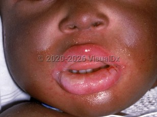 Clinical image of Chediak-Higashi syndrome - imageId=1481679. Click to open in gallery.  caption: 'Silver-gray hue of facial skin.'