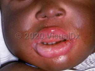 Clinical image of Chediak-Higashi syndrome - imageId=1481679. Click to open in gallery.  caption: 'Silver-gray hue of facial skin.'
