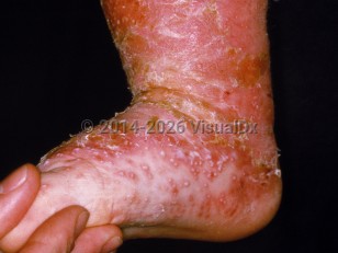 Clinical image of Infantile psoriasis - imageId=14990. Click to open in gallery.  caption: 'Pustular psoriasis in an infant displaying a large crusted and scaly erythematous plaque on the leg and foot, with outlying tiny pustules on the foot.'