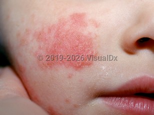 Enteroviral infection
