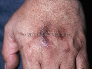 Clinical image of Drug-induced pigmentation - imageId=152129. Click to open in gallery.  caption: 'Brown and violaceous macules and patches on the dorsal hands, developing secondary to medication.'