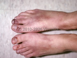Clinical image of Granulomatosis with polyangiitis - imageId=153379. Click to open in gallery.  caption: 'Hemorrhagic bullae and vesicles on the distal toes and faint, maroon-colored patches on the dorsal feet.'