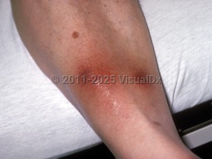 Clinical image of Pancreatic panniculitis - imageId=153599. Click to open in gallery.  caption: 'Purpuric nodules with surrounding erythema on the lower shin.'