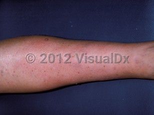 Clinical image of Calciphylaxis - imageId=153991. Click to open in gallery.  caption: 'A circumferential, erythematous plaque on the lower leg.'