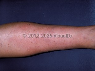 Clinical image of Calciphylaxis - imageId=153991. Click to open in gallery.  caption: 'A circumferential, erythematous plaque on the lower leg.'