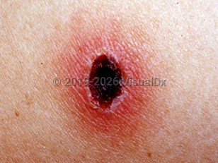 Clinical image of Scrub typhus - imageId=1554211. Click to open in gallery.  caption: 'A close-up of an eschar with a bright red border.'