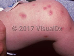 Clinical image of Takayasu arteritis - imageId=1573507. Click to open in gallery.  caption: 'Purpuric papules, some with central papules, and a purpuric patch on the leg.'