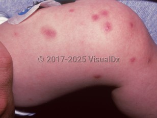 Clinical image of Takayasu arteritis - imageId=1573507. Click to open in gallery.  caption: 'Purpuric papules, some with central papules, and a purpuric patch on the leg.'
