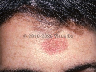 Clinical image of Traumatic purpura - imageId=1587737. Click to open in gallery.  caption: 'An oval purpuric patch on the forehead secondary to suction.'