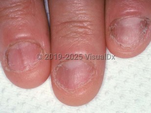 Clinical image of Nail biting - imageId=1655004. Click to open in gallery.  caption: 'Distal fraying of the nails, enlarged lunulae, and faint longitudinal melanonychia.'