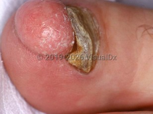 Clinical image of Subungual fibroma - imageId=1663452. Click to open in gallery.  caption: 'A pink nodule with overlying scant scale at the distal toe, causing lifting of the toenail.'