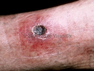 Clinical image of Rickettsialpox - imageId=167281. Click to open in gallery.  caption: 'An eschar with a surrounding erythematous plaque on the leg.'