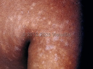 Clinical image of Pityriasis lichenoides chronica - imageId=17098. Click to open in gallery.  caption: 'Scaly, flat-topped, violaceous papules and plaques and postinflammatory hypopigmented macules on the arm and shoulder area.'