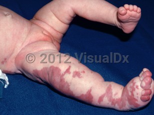 Clinical image of Klippel-Trenaunay syndrome - imageId=1712604. Click to open in gallery.  caption: 'A broad maroon plaque (port wine stain) and hemihypertrophy of the leg.'