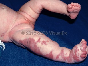 Clinical image of Klippel-Trenaunay syndrome - imageId=1712604. Click to open in gallery.  caption: 'A broad maroon plaque (port wine stain) and hemihypertrophy of the leg.'