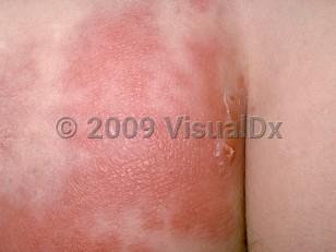 Clinical image of Erysipelas - imageId=175775. Click to open in gallery.  caption: 'A close-up of a deeply erythematous, edematous, and vesiculated patterned plaque on the buttock.'
