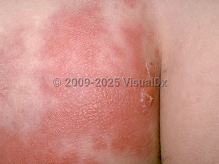 Clinical image of Erysipelas - imageId=175775. Click to open in gallery.  caption: 'A close-up of a deeply erythematous, edematous, and vesiculated patterned plaque on the buttock.'