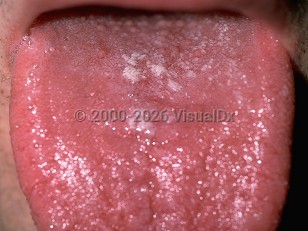 Oral candidiasis