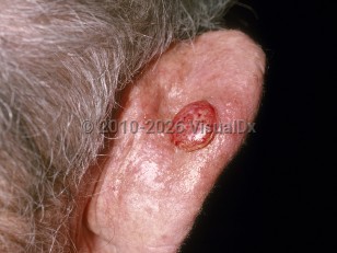 Clinical image of Cutaneous squamous cell carcinoma - imageId=178723. Click to open in gallery.  caption: 'An eroded nodule on the posterior pinna.'