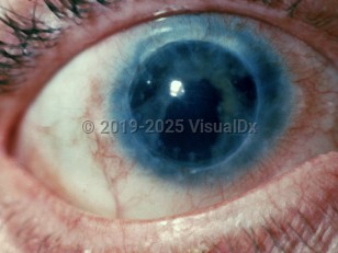 Clinical image of Ocular syphilis - imageId=1805002. Click to open in gallery.  caption: 'Interstitial keratitis. '