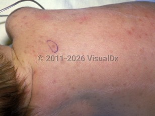 Clinical image of Hemophagocytic lymphohistiocytosis - imageId=1817716. Click to open in gallery.  caption: 'Reddish and brownish macules and papules scattered over the back.'