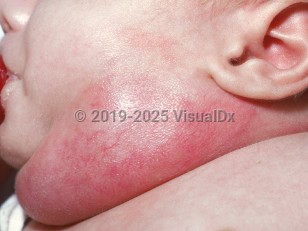 Clinical image of Abscess of the newborn - imageId=1823631. Click to open in gallery.  caption: 'A giant, deep red nodule on the neck from <i>Staphylococcus aureus</i>.'
