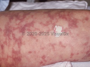 Clinical image of Disseminated intravascular coagulation - imageId=184015. Click to open in gallery.  caption: 'Retiform purpura on the thigh.'
