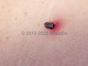 Clinical image of Tick bite - imageId=1856076. Click to open in gallery.  caption: 'A partially engorged, embedded tick with surrounding bright red erythema.'