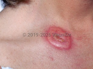 Acute febrile neutrophilic dermatosis
