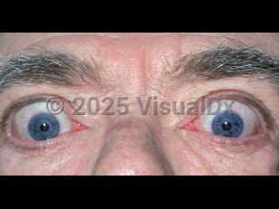 Clinical image of Graves ophthalmopathy - imageId=1858880. Click to open in gallery.  caption: 'Proptosis secondary to Graves disease.'
