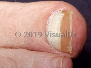 Clinical image of Proximal subungual onychomycosis - imageId=1862878. Click to open in gallery.  caption: 'Diffuse white discoloration of the proximal great toenail.'