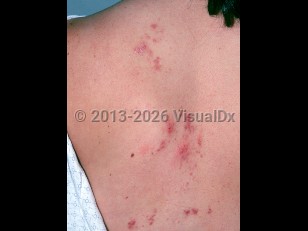 Clinical image of Schistosomiasis - imageId=1865792. Click to open in gallery.  caption: 'Excoriated and crusted erythematous papules and plaques on the back.'