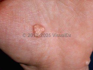 Clinical image of Calcinosis cutis - imageId=187712. Click to open in gallery.  caption: 'Yellow and white small plaques with irregular surfaces on the palm.'
