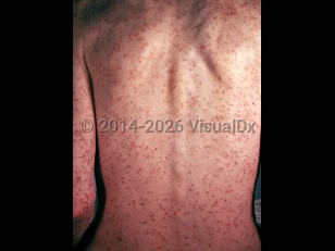 Clinical image of Colorado tick fever - imageId=1890149. Click to open in gallery.  caption: 'Widespread deeply erythematous macules and papules on the back and arms.'