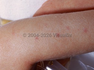 Clinical image of Cytomegalovirus infection of newborn - imageId=1893590. Click to open in gallery.  caption: 'Reddish papules on the arm ("blueberry muffin" lesions associated with cytomegalic inclusion disease).'