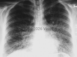 Imaging Studies image of Hantavirus cardiopulmonary syndrome - imageId=1909910. Click to open in gallery. 