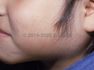 Clinical image of Mumps - imageId=1917887. Click to open in gallery.  caption: 'Marked parotidomegaly.'