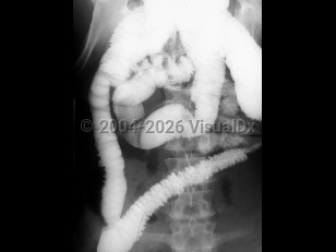 Amebic colitis